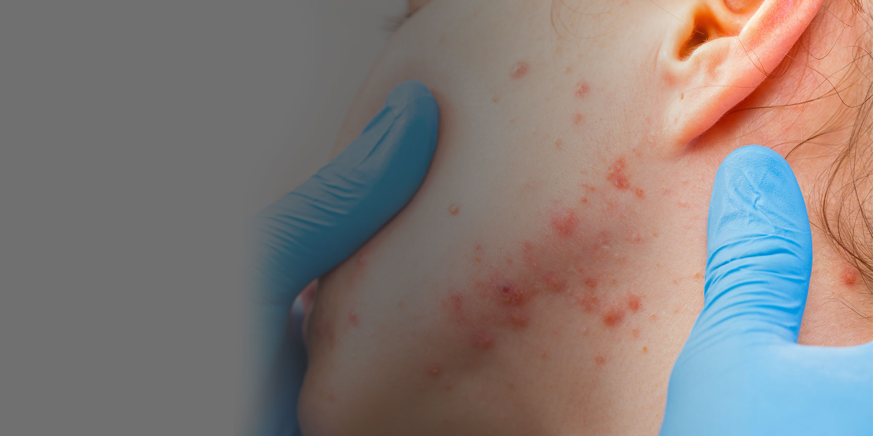 DermoDirect dermatologists are acne experts