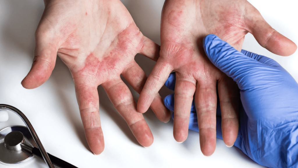 Understanding contact dermatitis: Symptoms, causes, and treatment