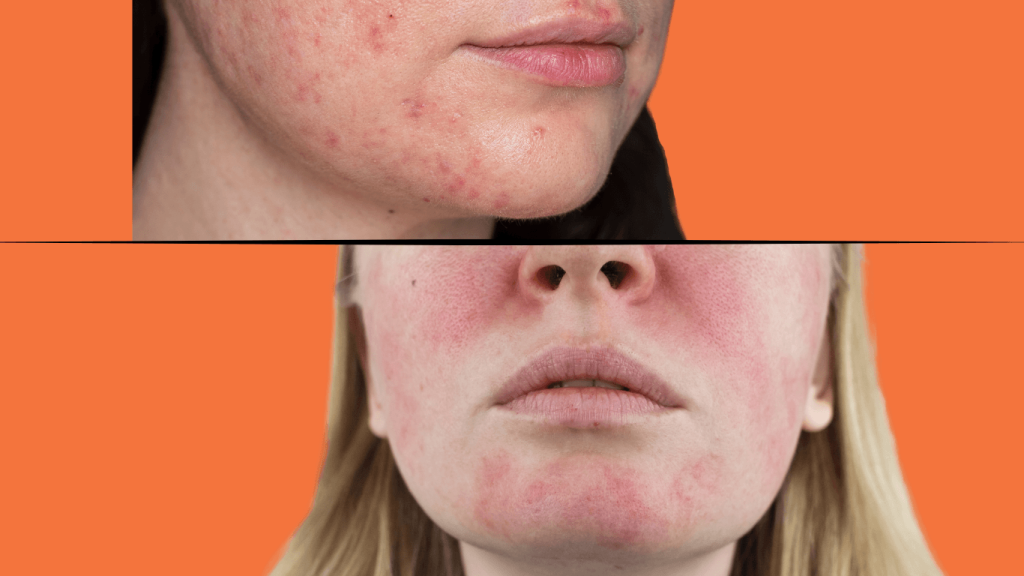 Rosacea remedies: How to soothe and manage this chronic skin condition