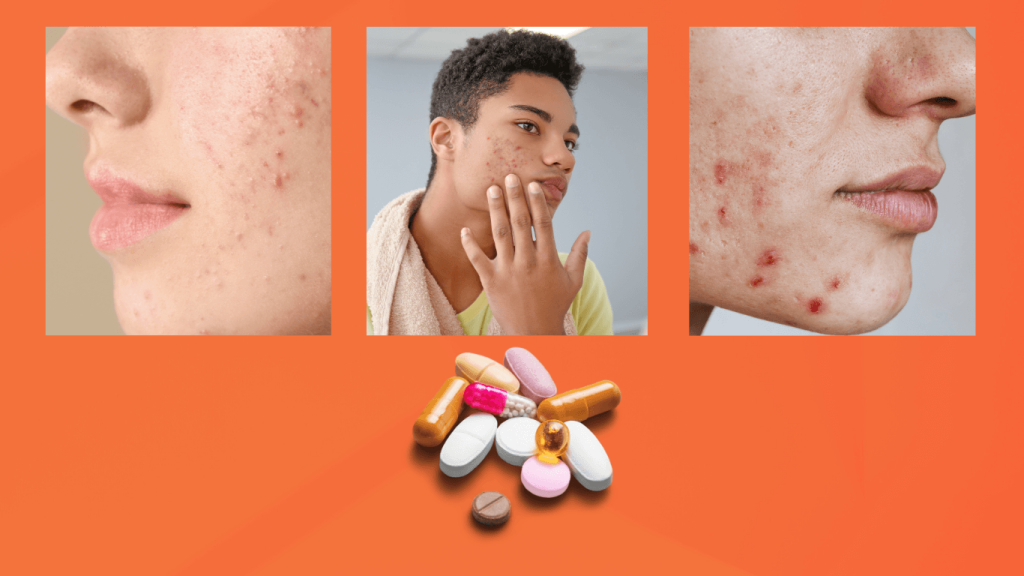 Your isotretinoin acne treatment journey: A step-by-step guide