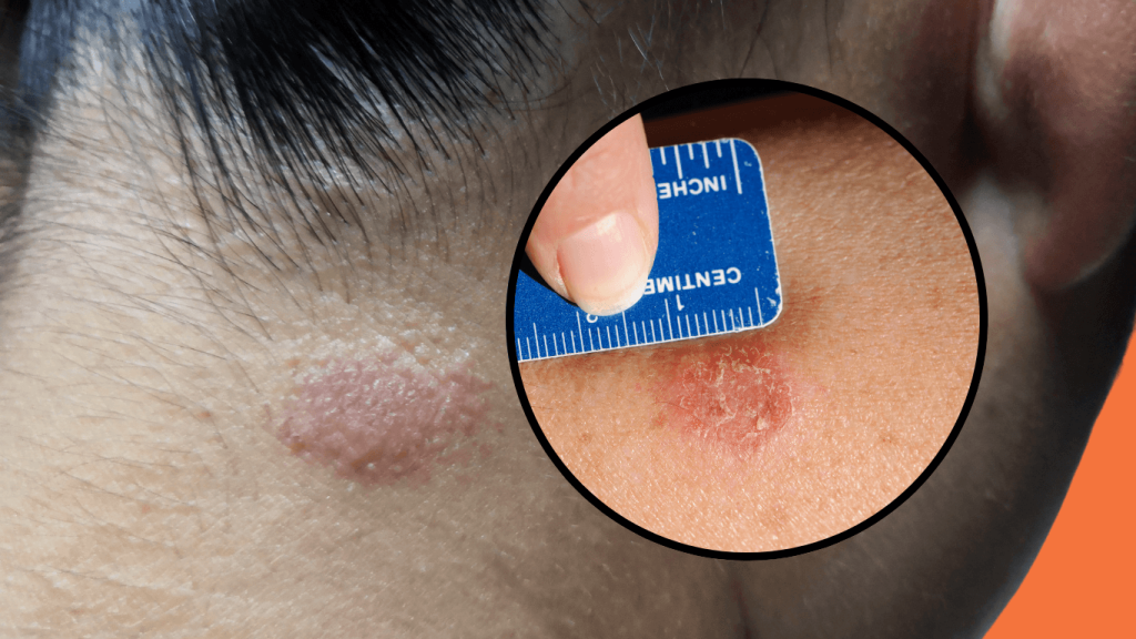How to treat and prevent tinea: a complete guide to battling fungal infections