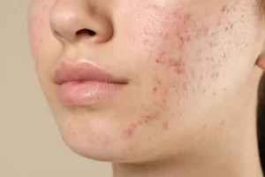 Acne Treatment in Australia