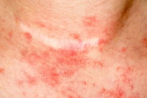 Eczema Treatment & Management Online