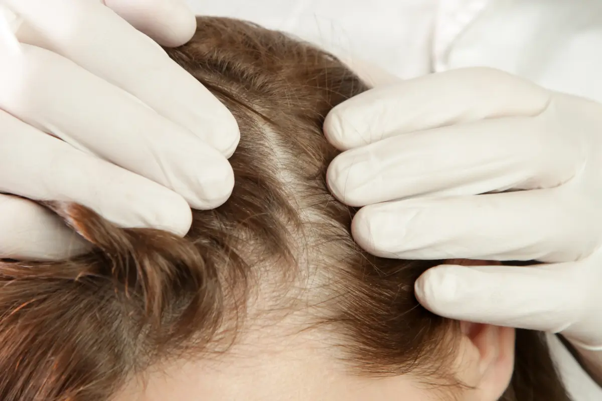Hair Diseases & Hair Loss Treatment Australia