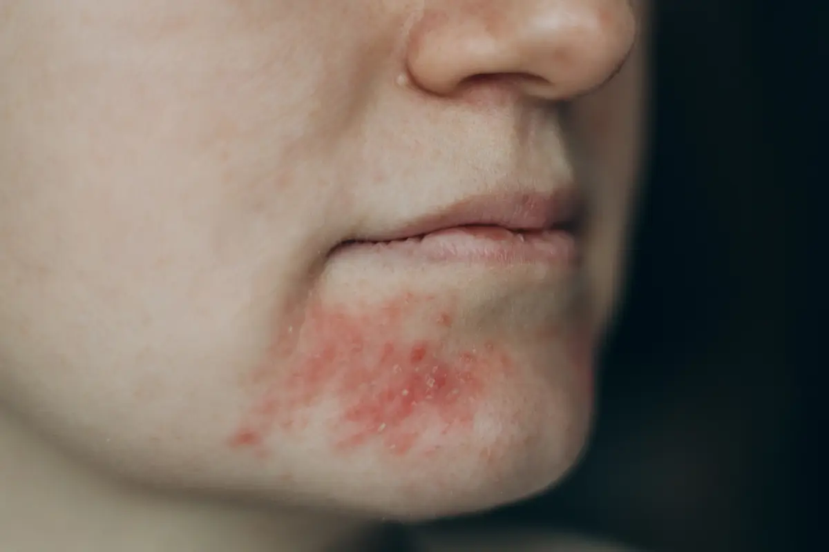 Perioral Dermatitis Treatment Australia