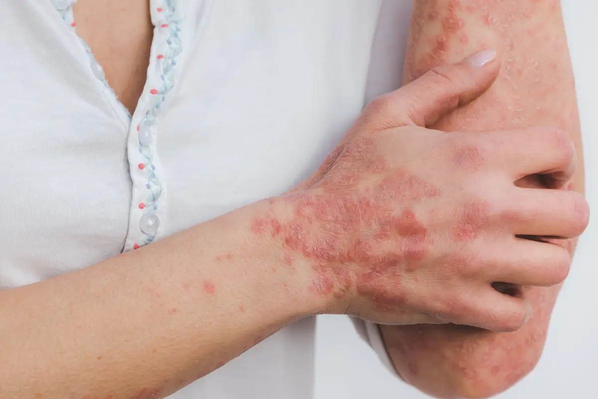 Psoriasis Treatment Australia