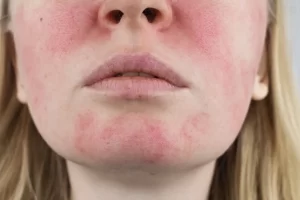 Rosacea Treatment & Management Online