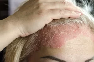 Seborrhoeic Dermatitis Treatment Online