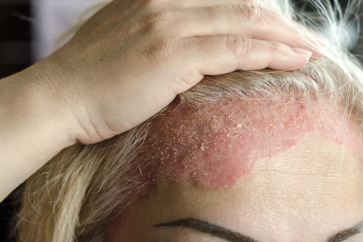 Seborrhoeic Dermatitis Treatment Online