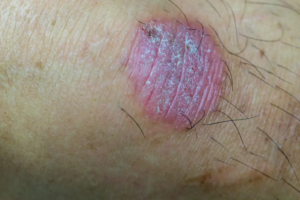 Tinea (Fungal Skin Infection) treatment Australia