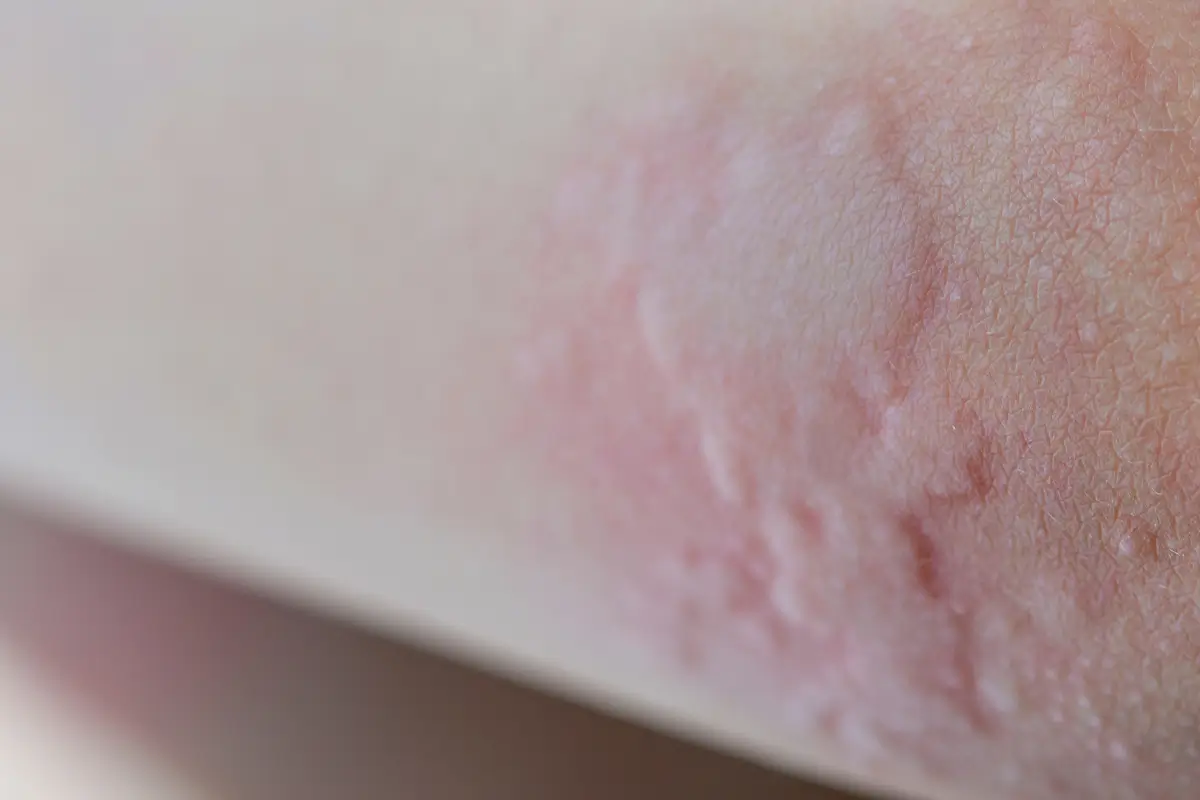 Urticaria (Hives) Treatment Australia