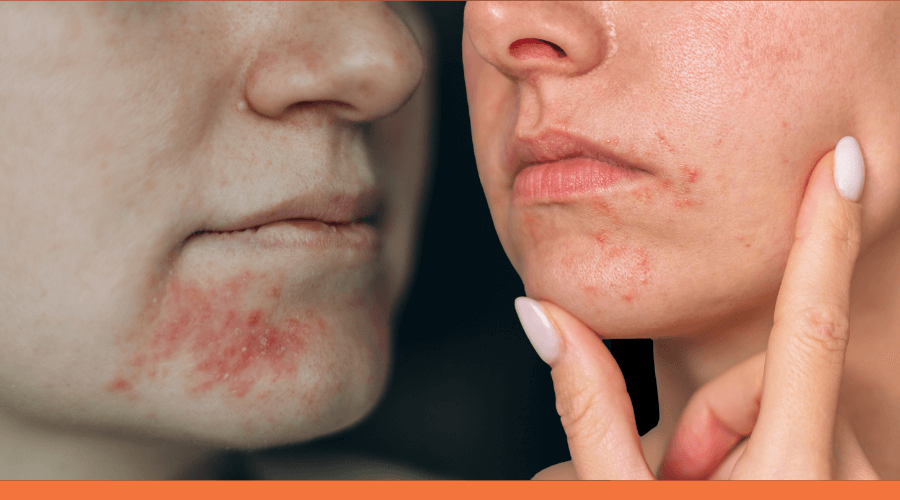 Perioral Dermatitis: Identifying and managing this persistent skin condition