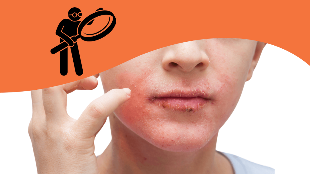 Perioral Dermatitis: Identifying and managing this persistent skin condition