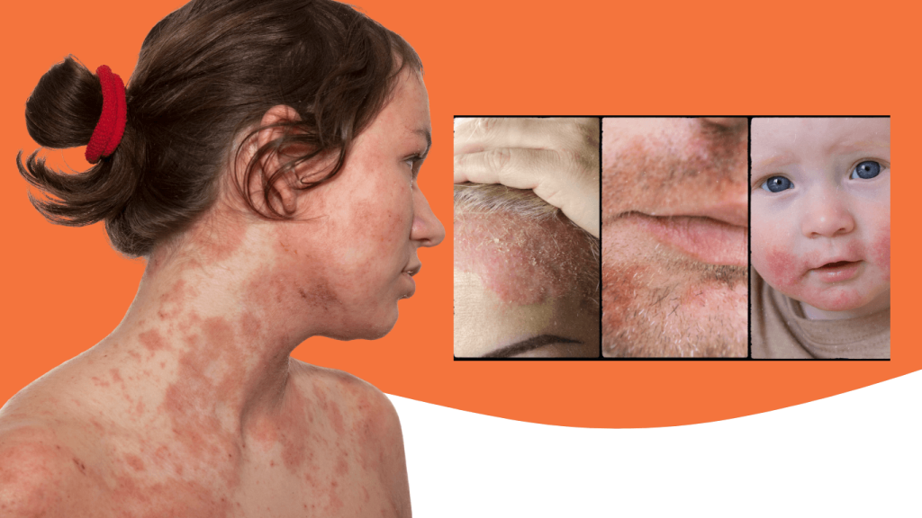 The ABCs of seborrhoeic dermatitis: Symptoms, causes, and treatment strategies