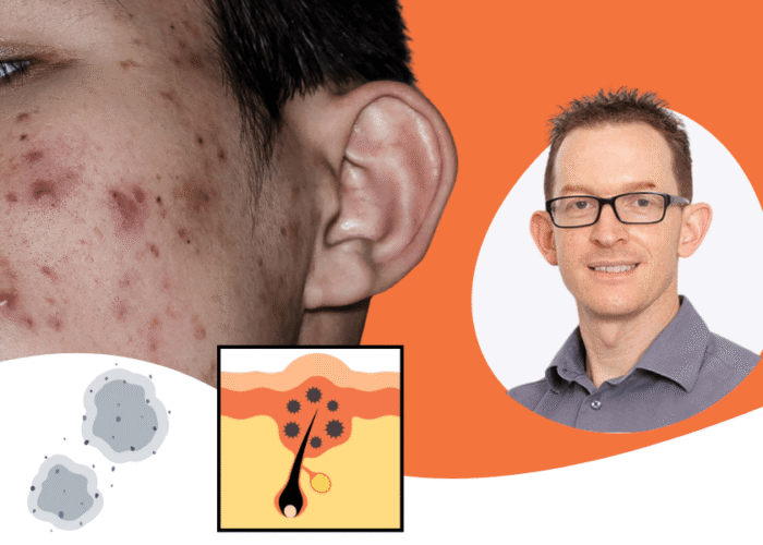 “Fungal Acne” — Why the Term Causes So Much Confusion (And What’s Really Going On)