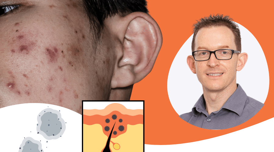 “Fungal Acne” — Why the Term Causes So Much Confusion (And What’s Really Going On)