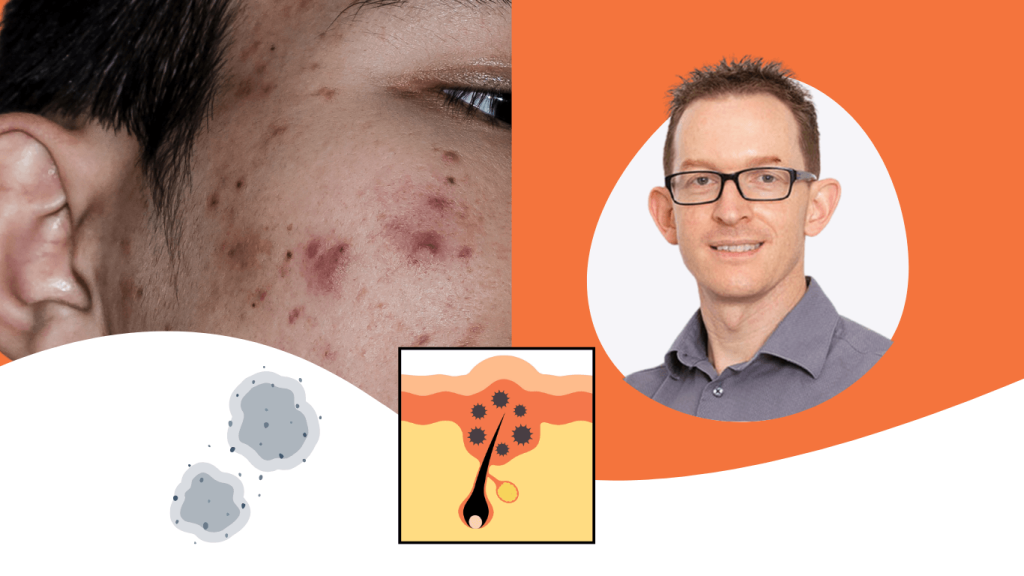 “Fungal Acne” — Why the Term Causes So Much Confusion (And What’s Really Going On)