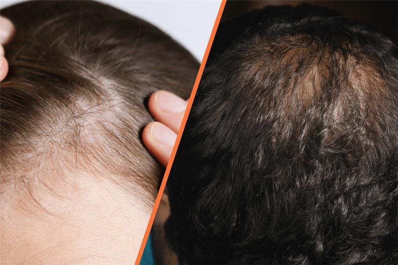 hair diseases including male and female pattern hair loss