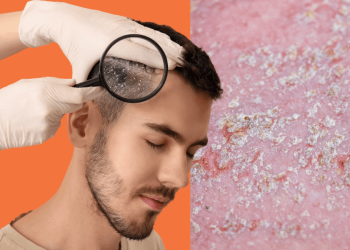 Seborrhoeic Dermatitis: What It Is, Why It Happens, and How to Manage It