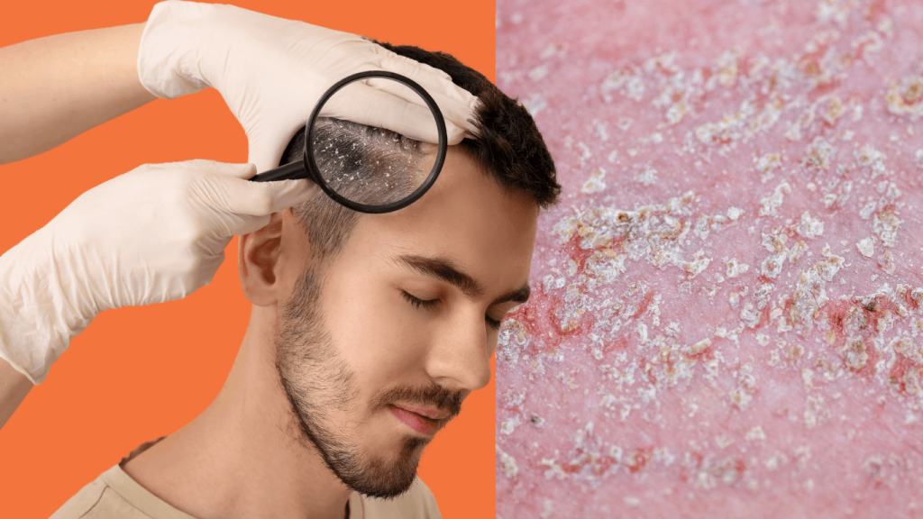 Seborrhoeic Dermatitis: What It Is, Why It Happens, and How to Manage It