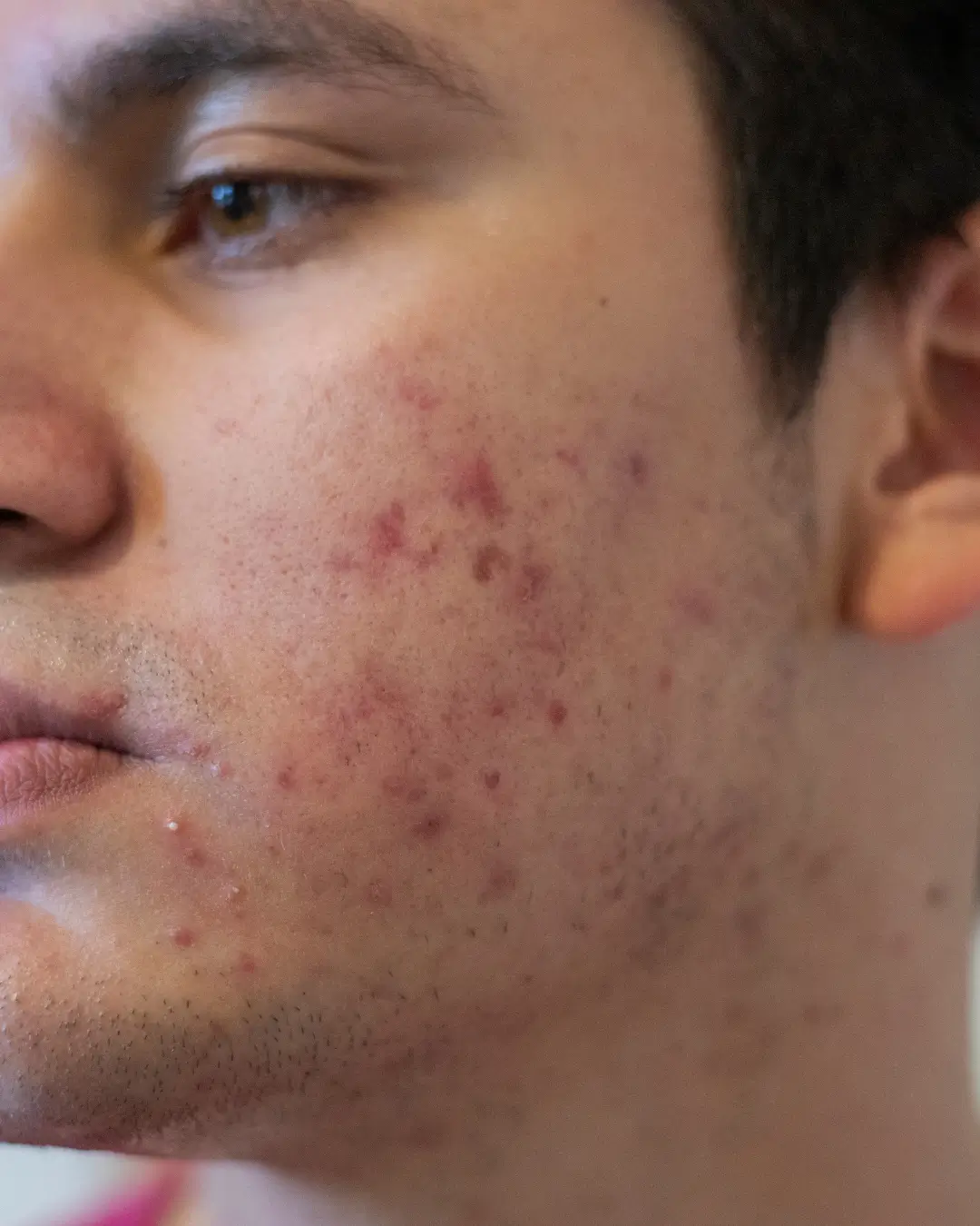 Men acne treatment Australia
