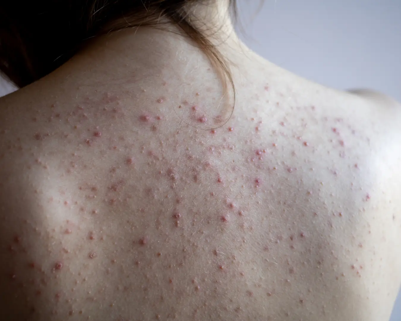 Back acne treatment Australia