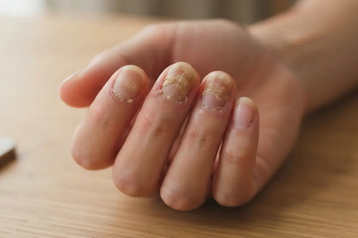 Nail diseases treatment Dermo Direct
