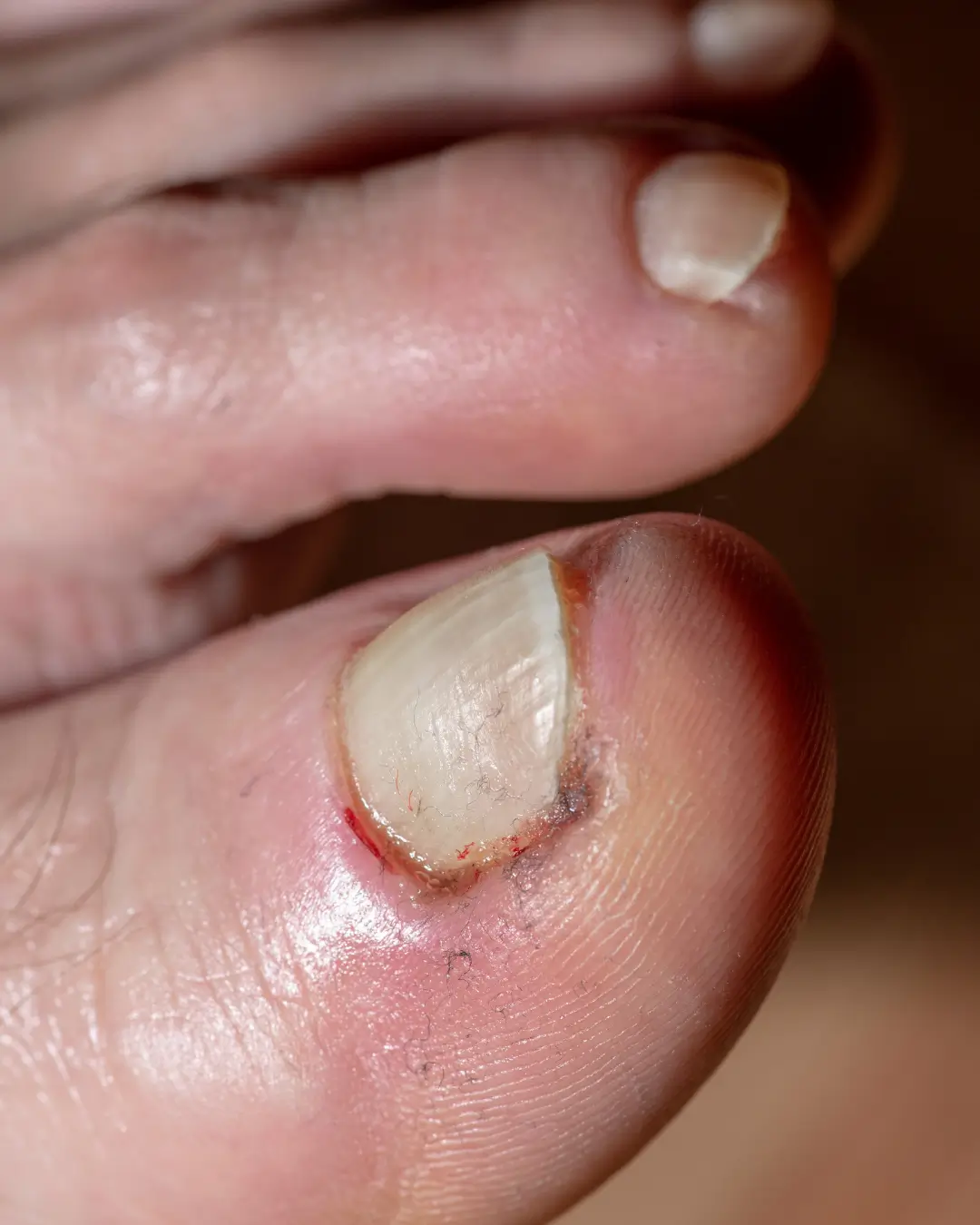 Nail Diseases on toe