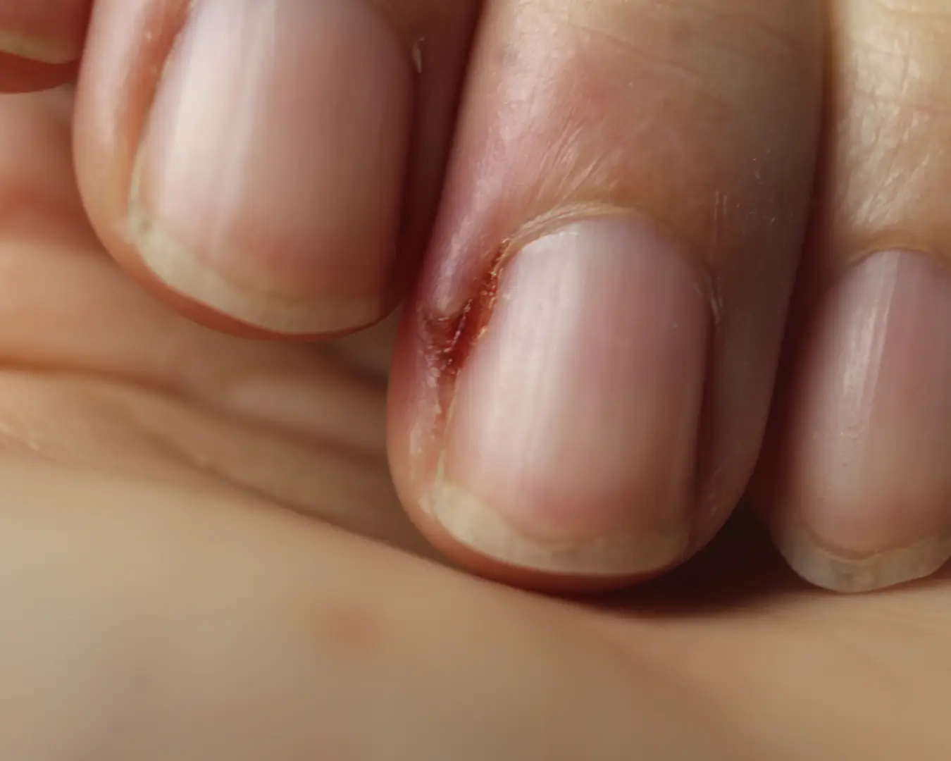 Nail Diseases treatment Australia