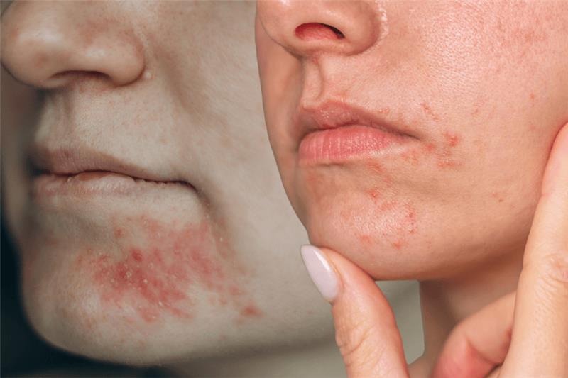 Perioral Dermatitis