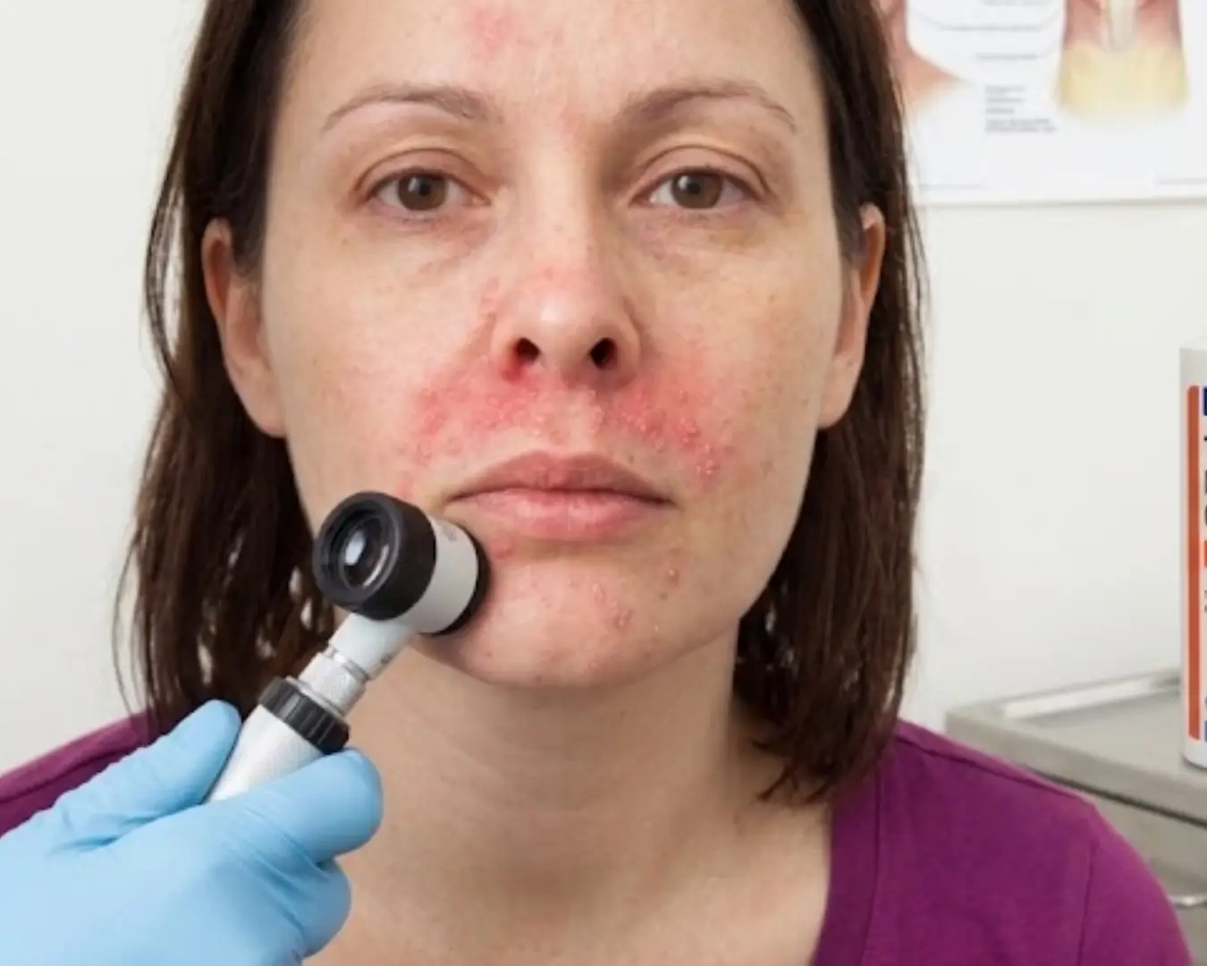 Perioral dermatitis treatment in australia