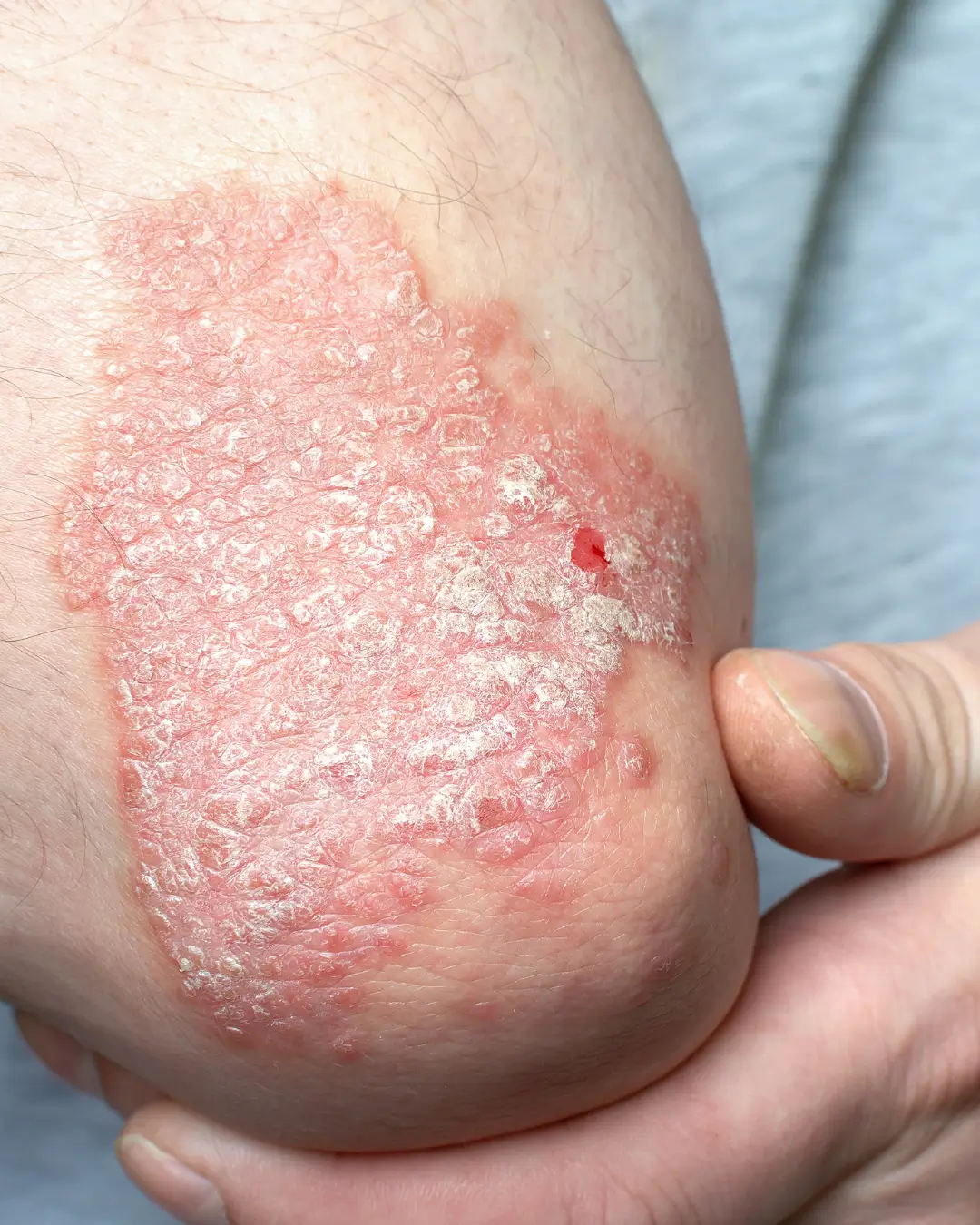 Psoriasis Treatment Australia