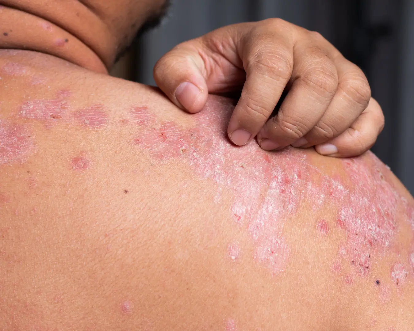 Psoriasis Treatment Australia online