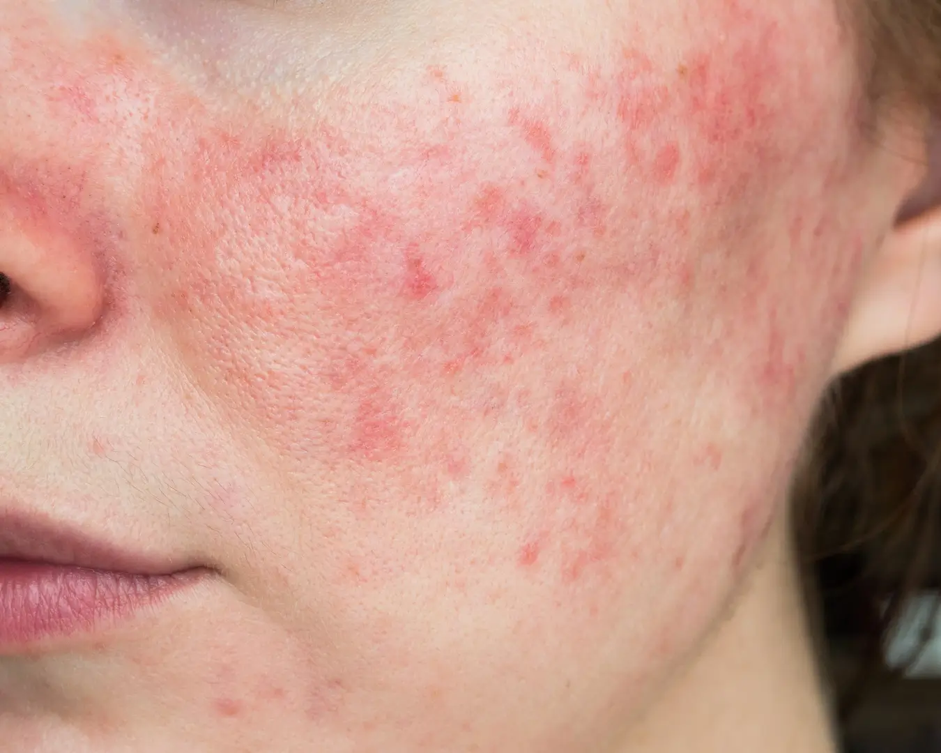 Rosacea Treatment & Management Online