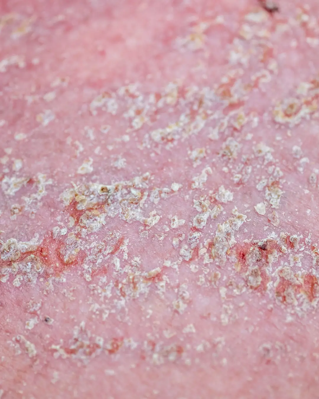 Seborrhoeic Dermatitis Treatment Online