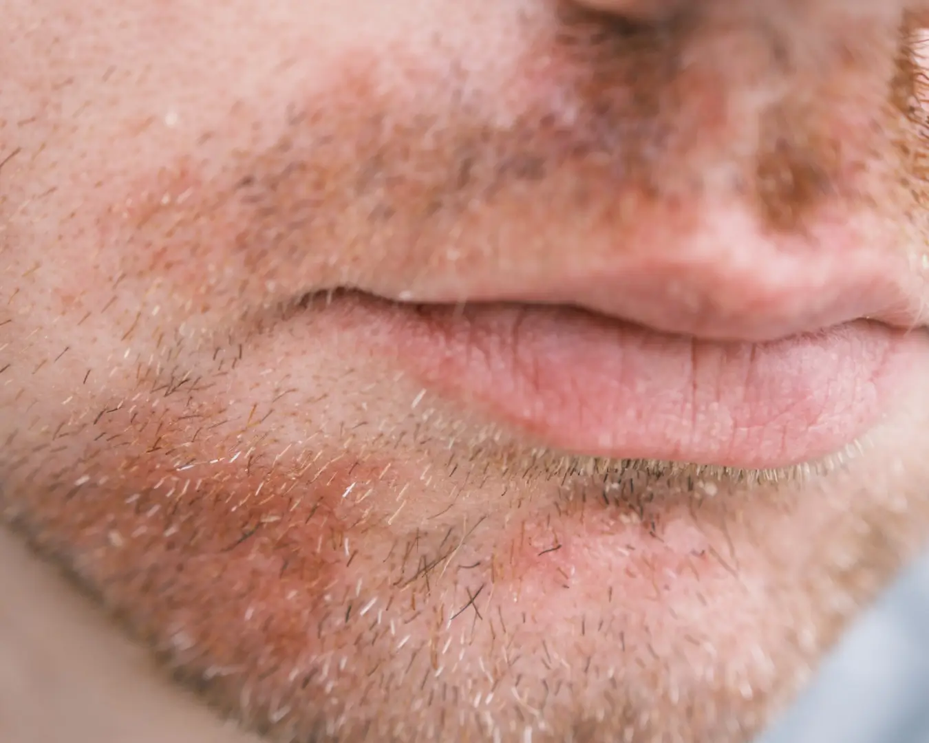 Seborrhoeic Dermatitis Treatment Online