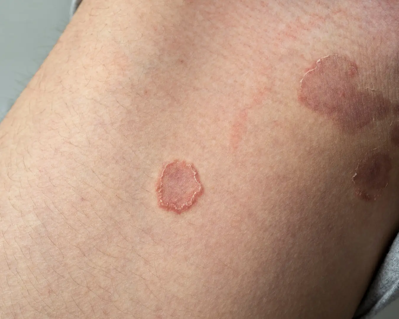Tinea (Fungal Skin Infection) treatment Australia online