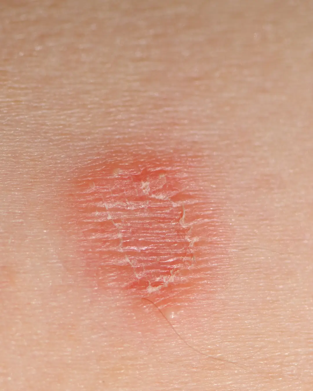 Tinea (Fungal Skin Infection) treatment Australia online