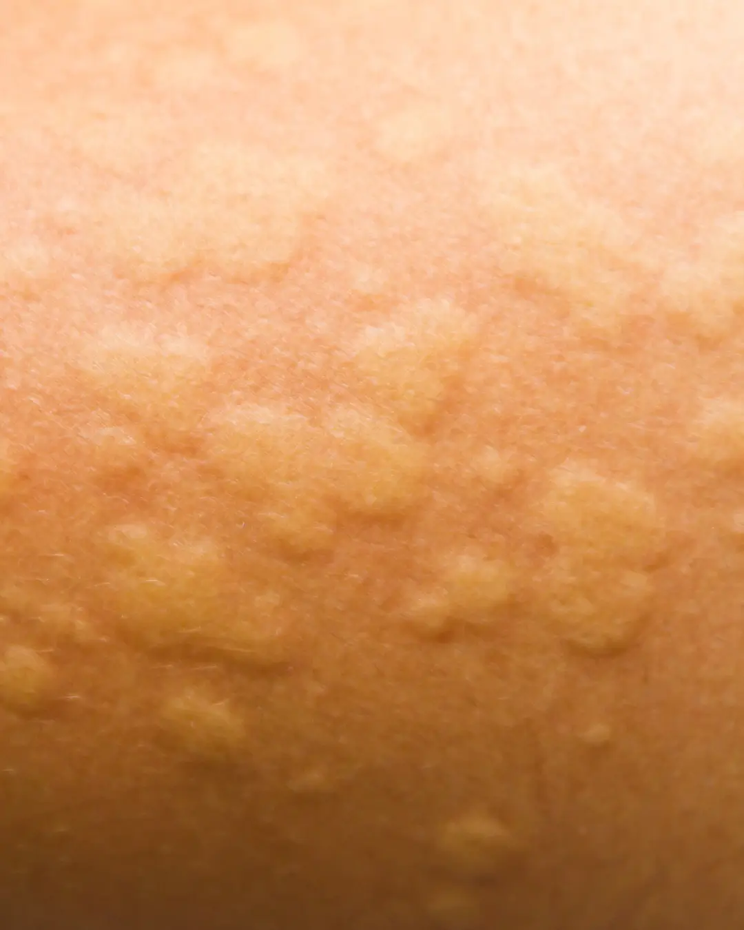 Urticaria (Hives) treatment Australia online