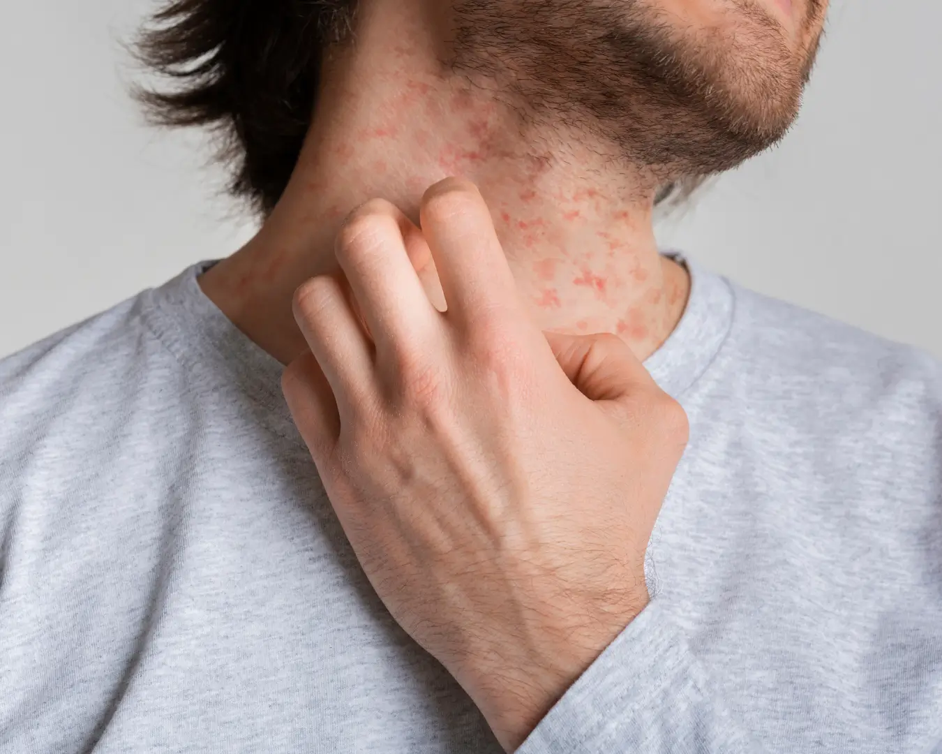 eczema treatment management Australia