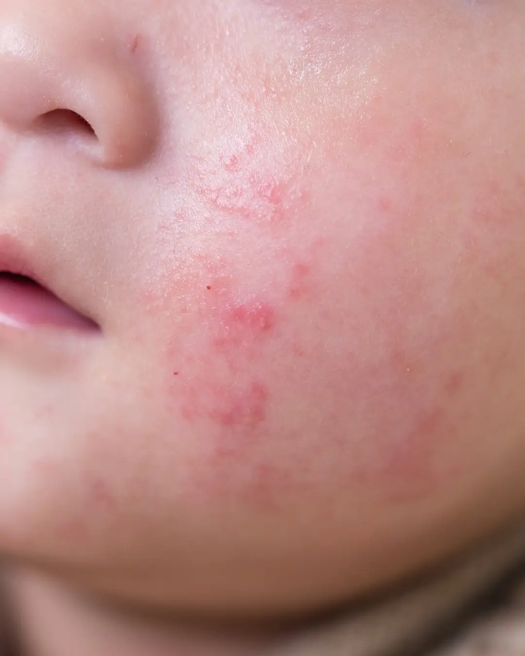 Children eczema treatment Australia