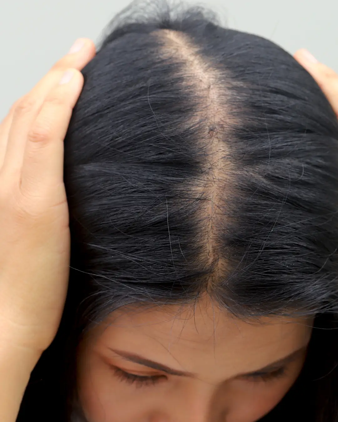 Female hair loss and hair diseases treatment Australia Online