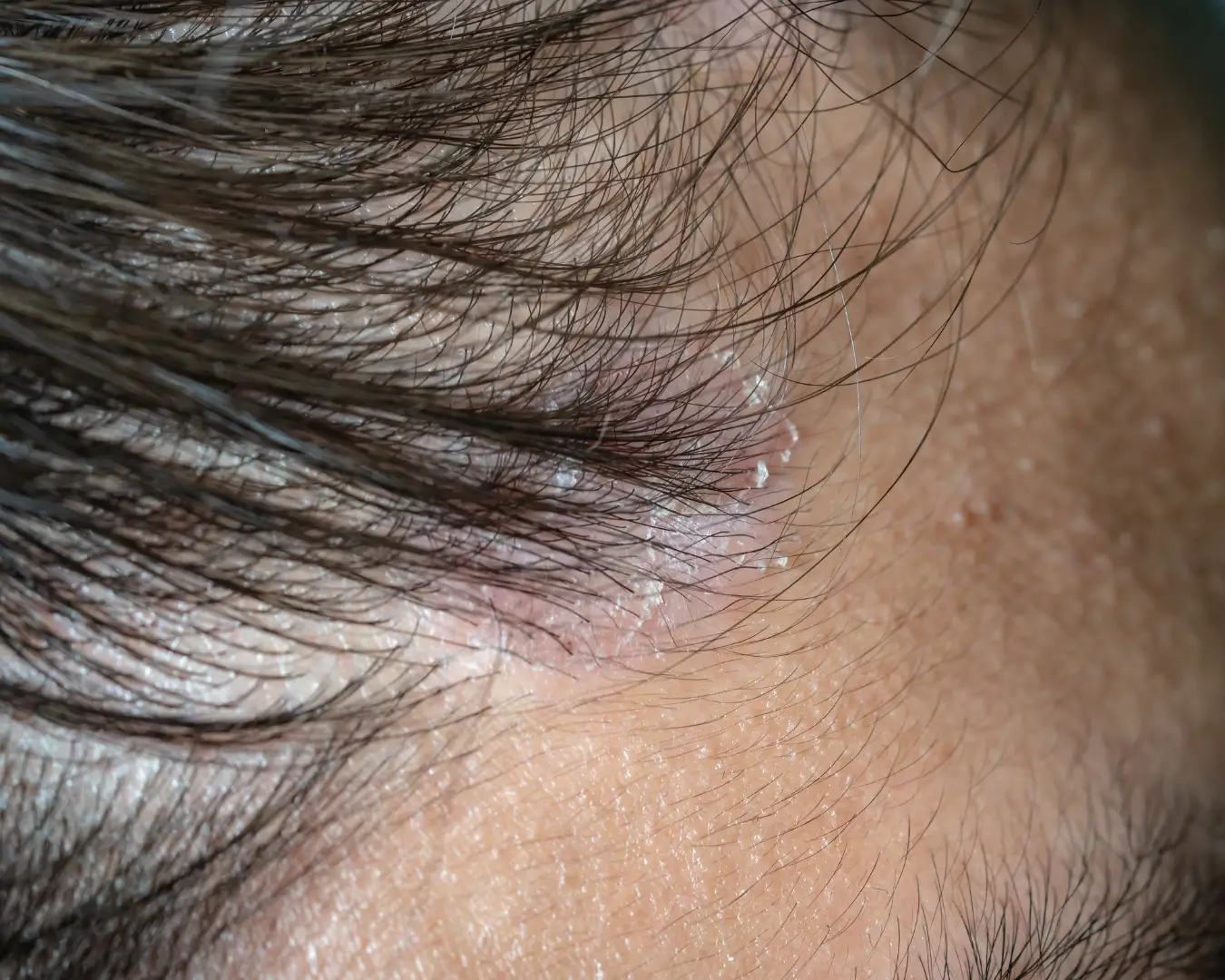 Hair loss and hair diseases treatment Australia