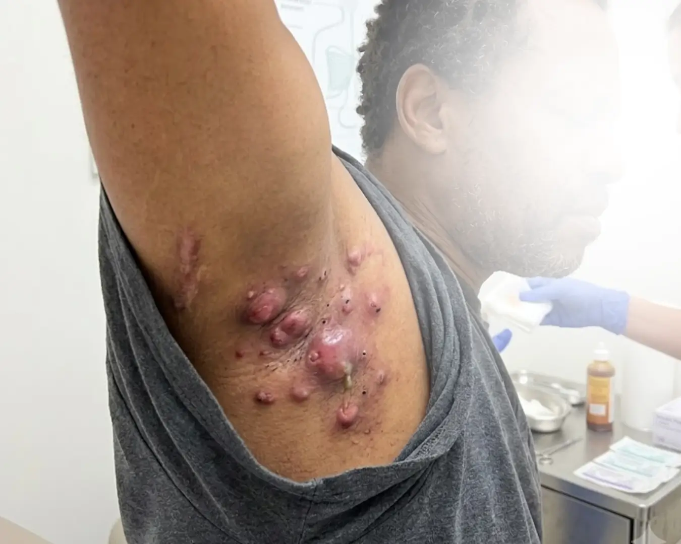 hidradenitis suppurativa treatment in australia